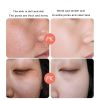 Anti Stains Acne Treatment Cream Scar Blackhead Face Cream Shrink Pores Whitening Skin Care Face Cream Korean Cosmetics